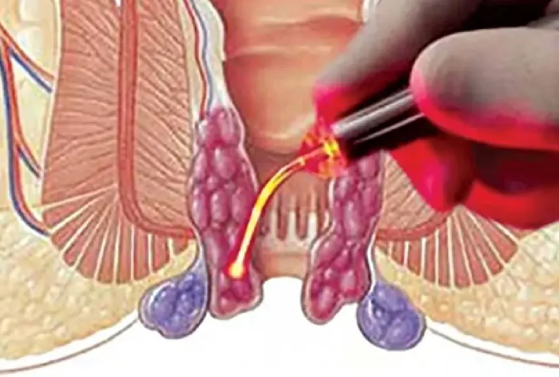 Experienced doctors for piles treatment with laser in Mashhad